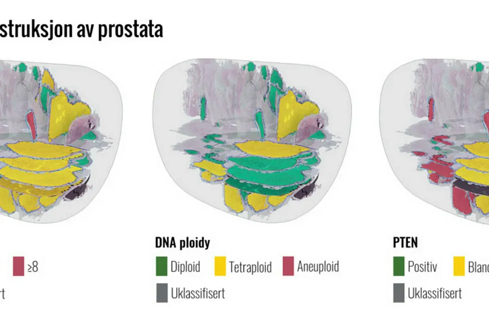 De tre vanligste metodene for å analysere kreftsvulster i prostata. De de fargede feltene viser endringer i pasientens i celler og vev. Rødt viser de alvorligste endringene, deretter gult og grønt. Nye forskningsresultater viser at variasjonene mellom hva de ulike testene finner er så store at det trengs utvikling av nye verktøy.
