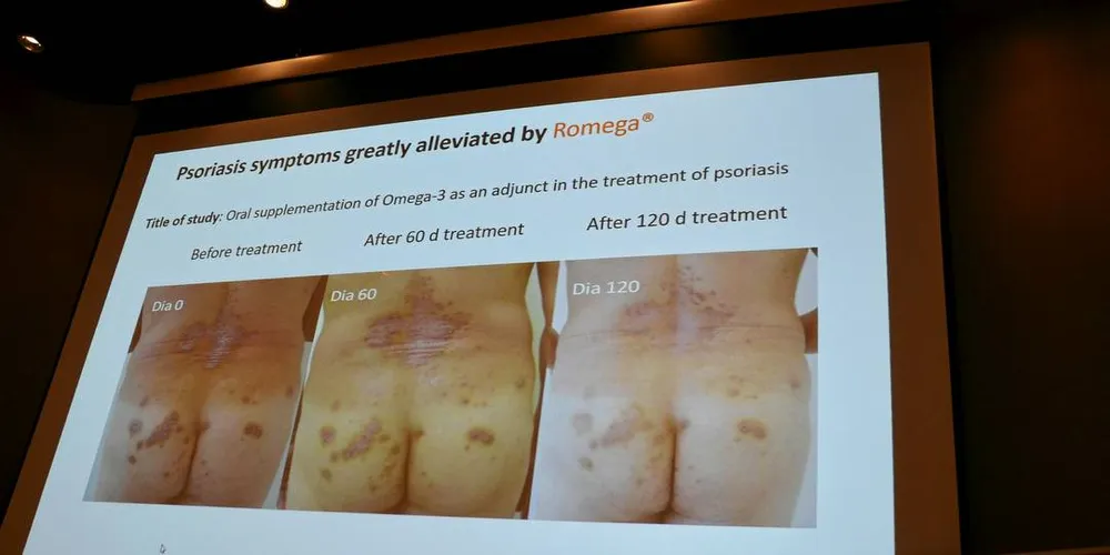 VIRKER: Forsøkene viser at produktene av silderogna virker mot psoriasis. Nå arbeides det for legemiddelgodkjenning av produktene.Foto: Einar Lindbæk